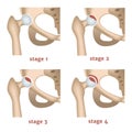 aseptic necrosis. Stages of destruction of the femoral head.